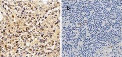 Low Expression of 14-3-3beta Is Associated With Adverse Survival of Diffuse Large B-Cell Lymphoma Patients